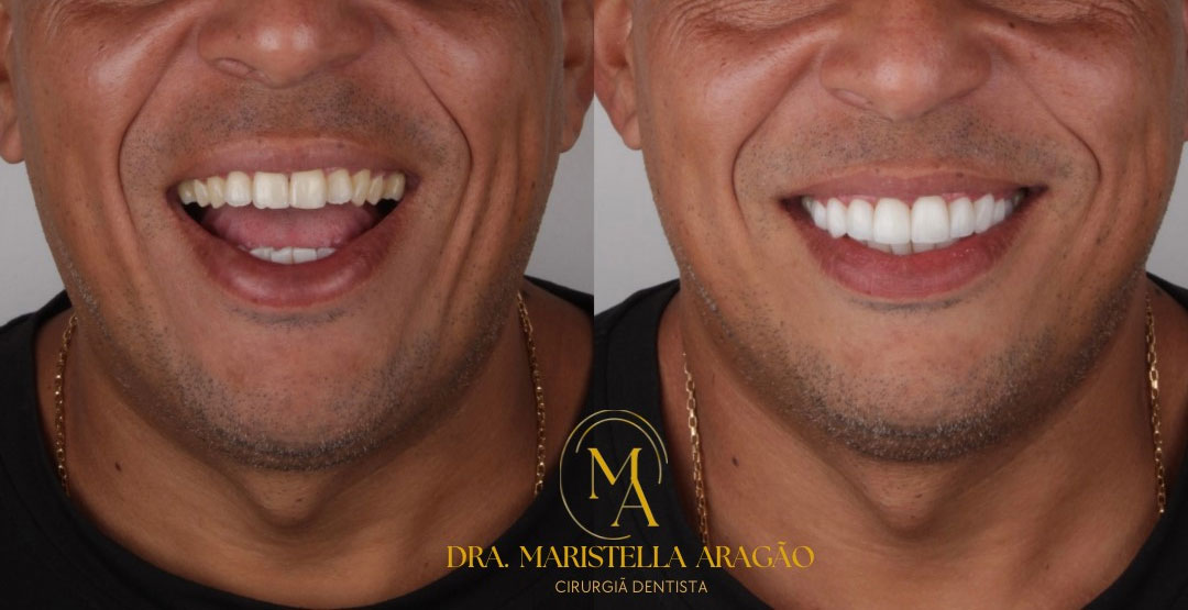 Lentes de Resina Dental em Nova Iguaçu