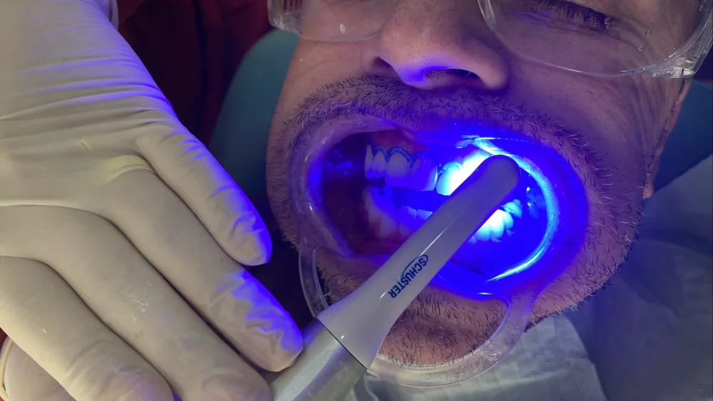 Clareamento Dental em Nova Iguaçu