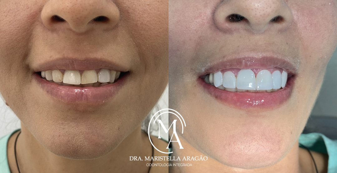 Vantagens das Lentes de Resina Dental em Nova Iguaçu