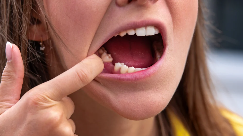 cuidados pós extração dente Nova Iguaçu