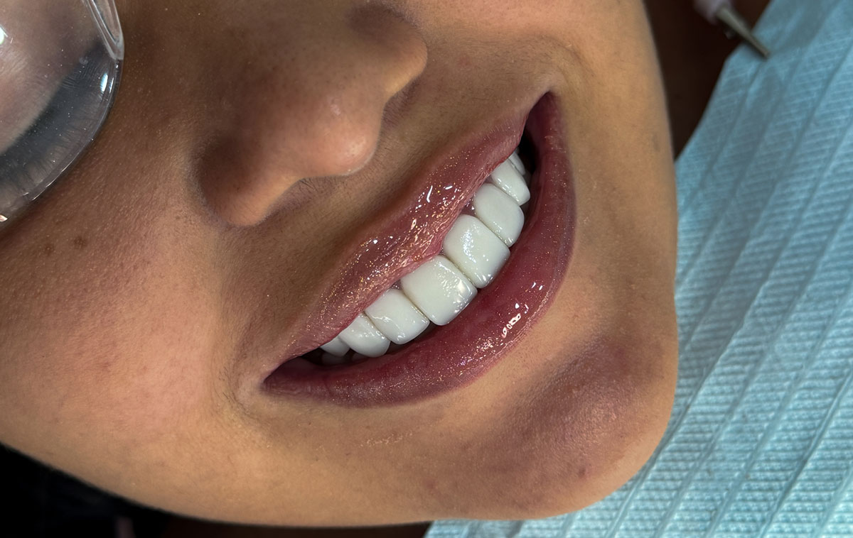 Odontologia Estética em Nova Iguaçu: Clareamento e Lentes de Resina com Toque Especial