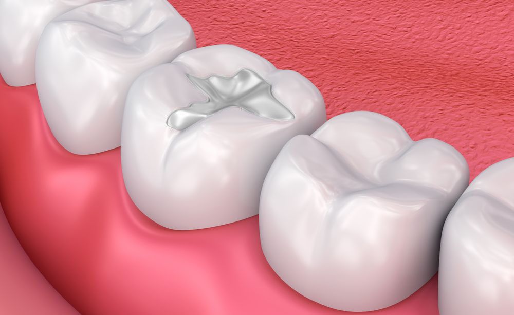 Quando trocar uma restauração dentária