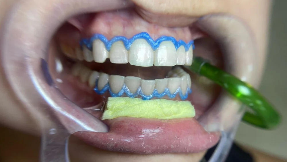 clareamento laser vs gel Nova Iguaçu