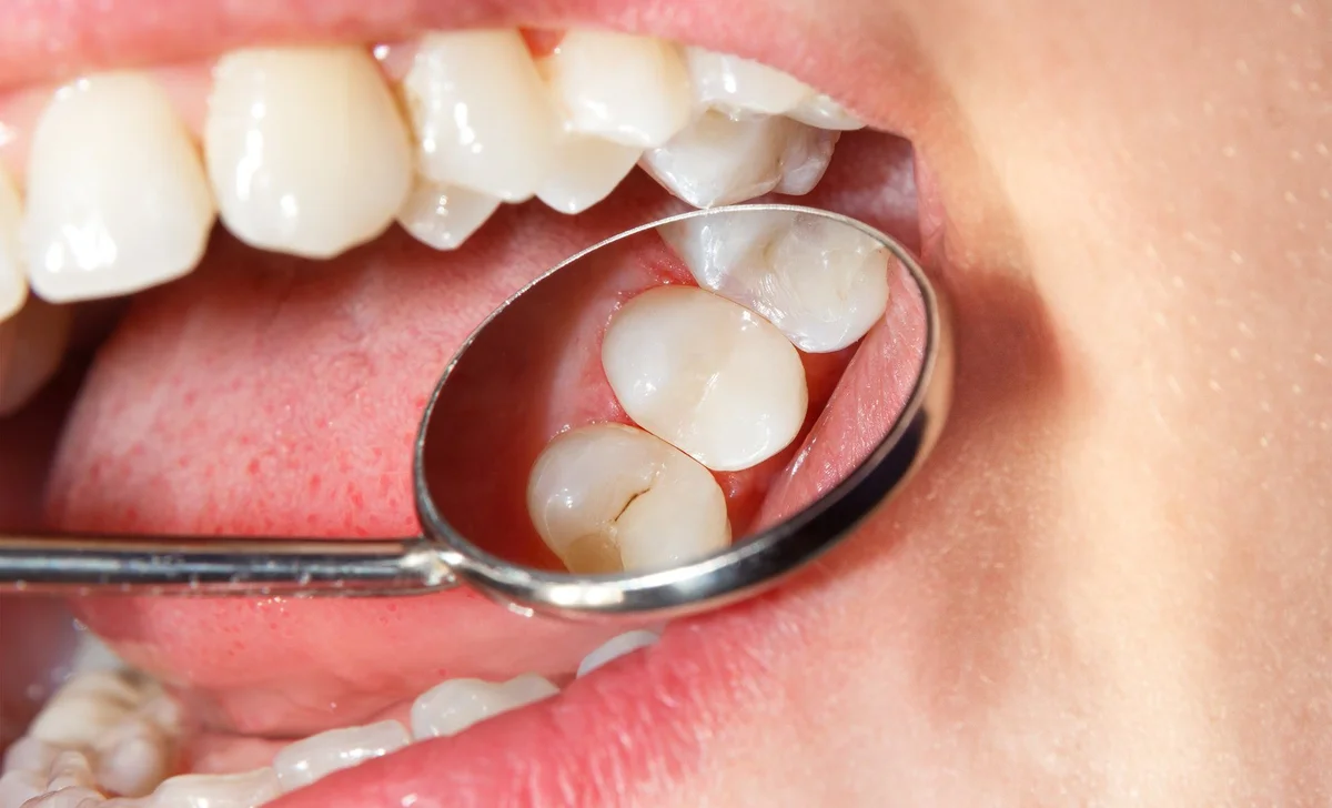 cuidar restauração dental nova iguaçu