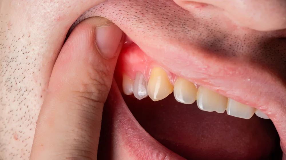 abscesso dentário